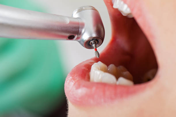 Best Emergency Wisdom Teeth Removal in Gloucester Point, VA